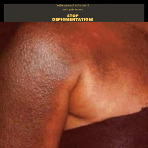 https://iboutchou.org Comment réparer sa peau après dépigmentation ?